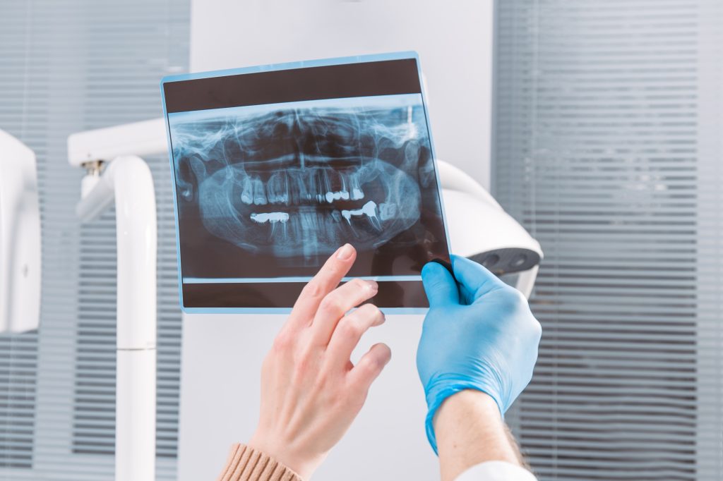 dentist reviewing xray for cavity between teeth