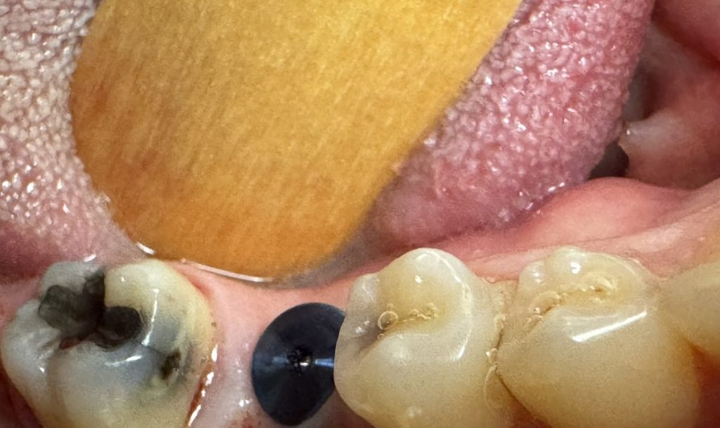 In the mouth. The small dark disc is the healing cap, which protects the implant while the bone fuses to it. The finished porcelain crown goes on top once healing is complete.