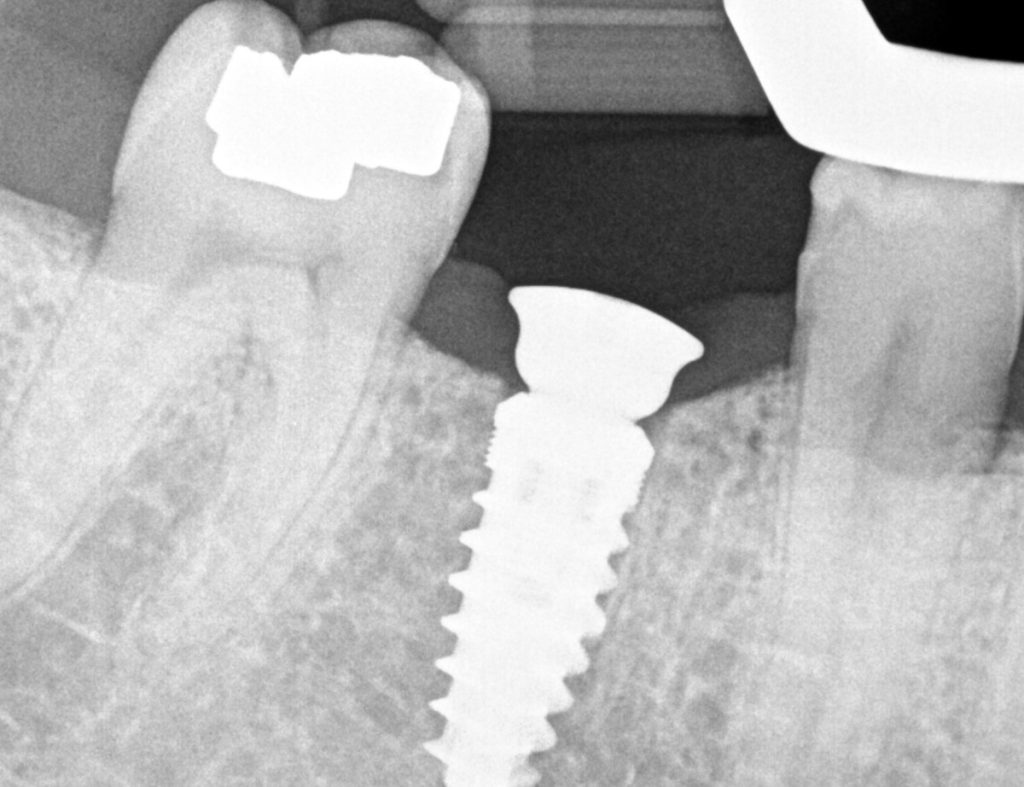 The X-ray. The titanium post is seated in the jawbone between two natural teeth, exactly where it was planned on the CBCT scan.